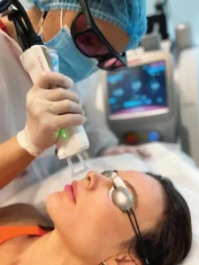 Face Laser Hair Removal