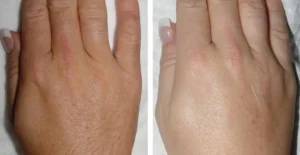 lhr hands: before after